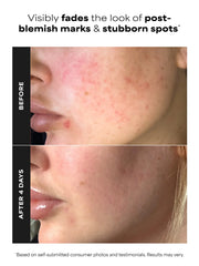 10% Azelaic Acid Booster