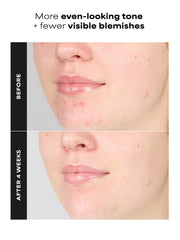 1% BHA Gentle Exfoliating Gel Toner