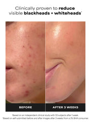 2% BHA Liquid Exfoliant