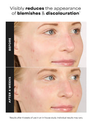 10% Azelaic Acid Booster